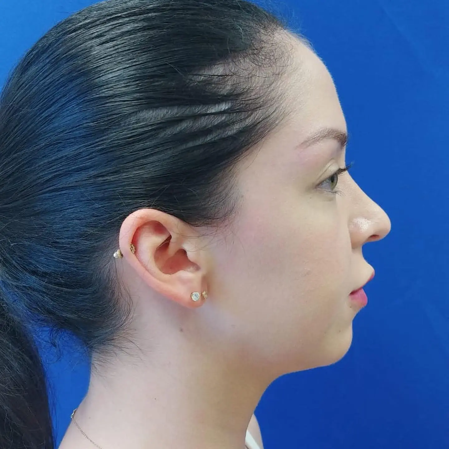 Patient profile view showing chin augmentation results in Fort Lee, NJ